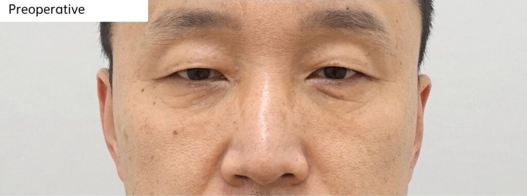 Preoperative appearance before revision lower blepharoplasty surgery in Korea