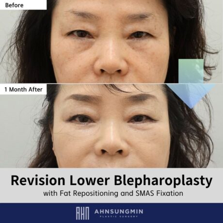 Revision Lower Blepharoplasty in Korea: Early Recovery After Structural Correction.