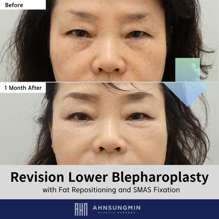 Revision Lower Blepharoplasty in Korea: Early Recovery After Structural Correction.