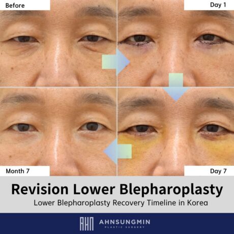 Revision Lower Blepharoplasty in Korea: Why Structural Support Matters More Than Aggressive Fat Removal.