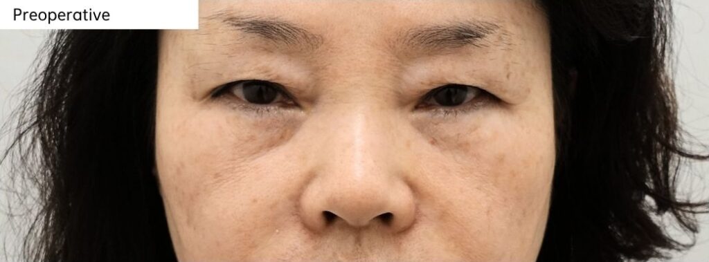 Preoperative appearance before revision lower blepharoplasty in Korea