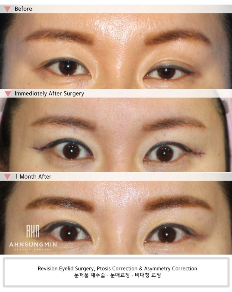Revision ptosis and eyelid asymmetry correction in Korea, showing before surgery, immediately after surgery, and 1-month recovery with more balanced eyelid opening.