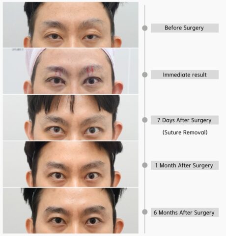Why Do Eyes Look Too Wide Open After Revision Ptosis Surgery?