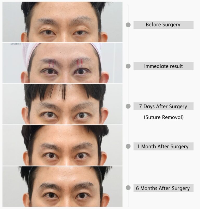 Why Do Eyes Look Too Wide Open After Revision Ptosis Surgery?