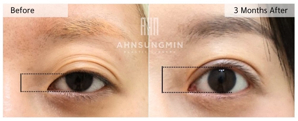 Before and three months after revision ptosis surgery showing improved eyelid opening and more balanced upper eyelid function