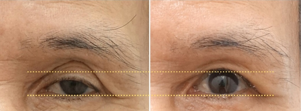 Before-and-after comparison showing improved eyelid opening one month after revision ptosis correction with orbital fat repositioning and crease lowering.