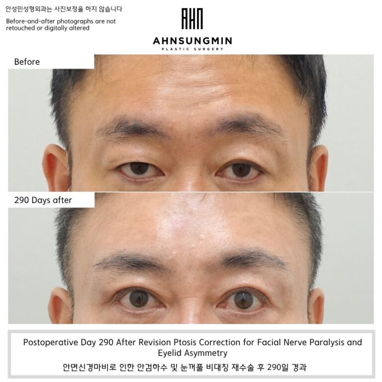Revision Ptosis Correction for Facial Nerve Paralysis and Eyelid Asymmetry.