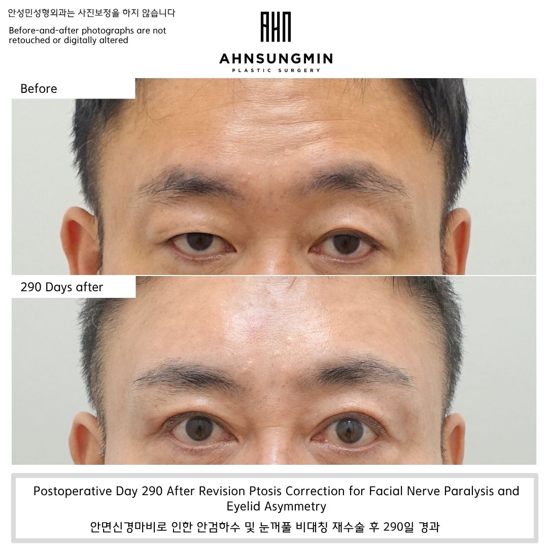 Revision ptosis correction for facial nerve paralysis and eyelid asymmetry in Korea, before and 290 days after surgery