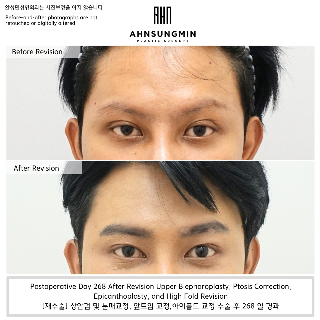 revision eyelid surgery before and after showing high fold, thick crease, ptosis, and forehead compensation improved at postoperative day 268