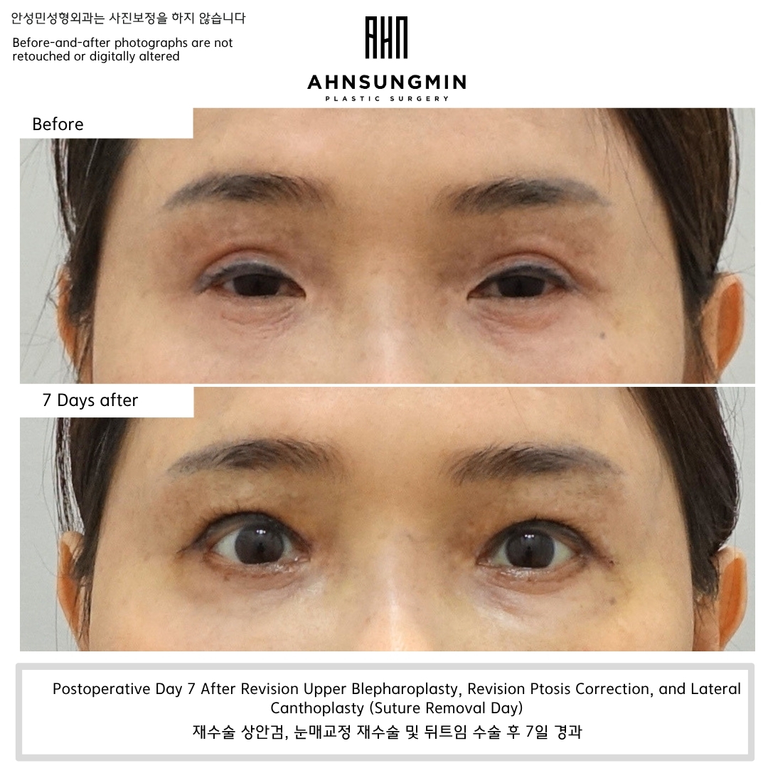 Postoperative Day 7 After Revision Upper Blepharoplasty, Revision Ptosis Correction, and Lateral Canthoplasty Showing Improved Eyelid Opening on Suture Removal Day