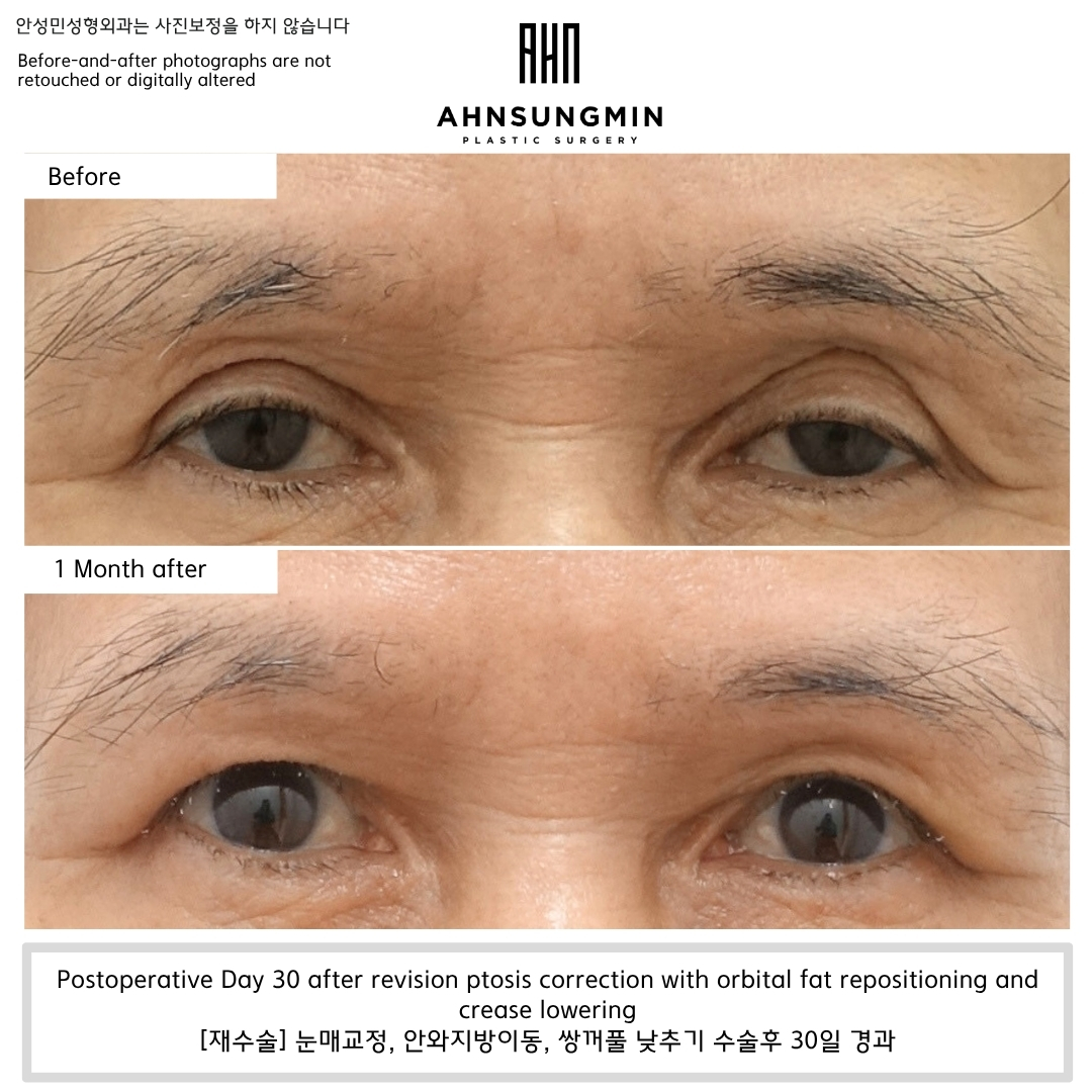 Revision ptosis correction with orbital fat repositioning and crease lowering showing 1-month postoperative improvement in eyelid opening and upper eyelid contour.