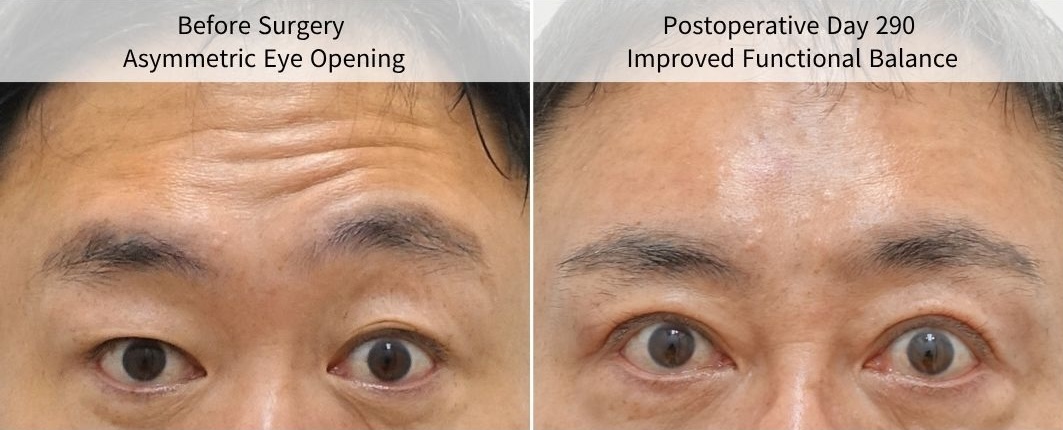 Before and postoperative day 290 after revision ptosis correction for facial nerve paralysis, showing improved functional eyelid balance