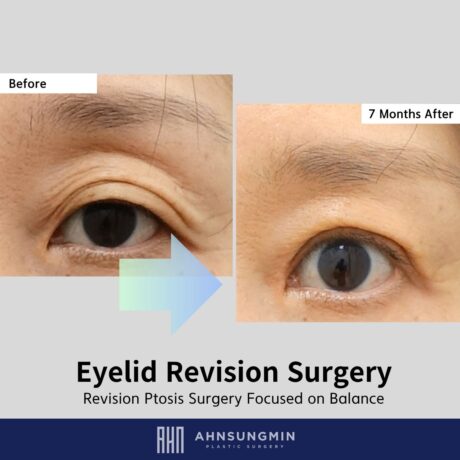 Why Multiple Eyelid Folds Sometimes Require Revision Surgery.