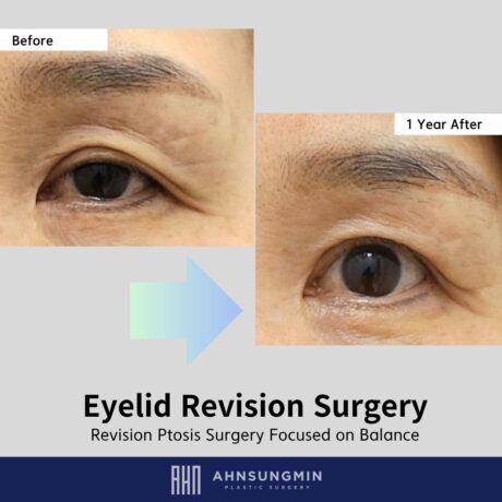 Why Revision Ptosis Surgery Should Not Focus Only on Bigger Eyes