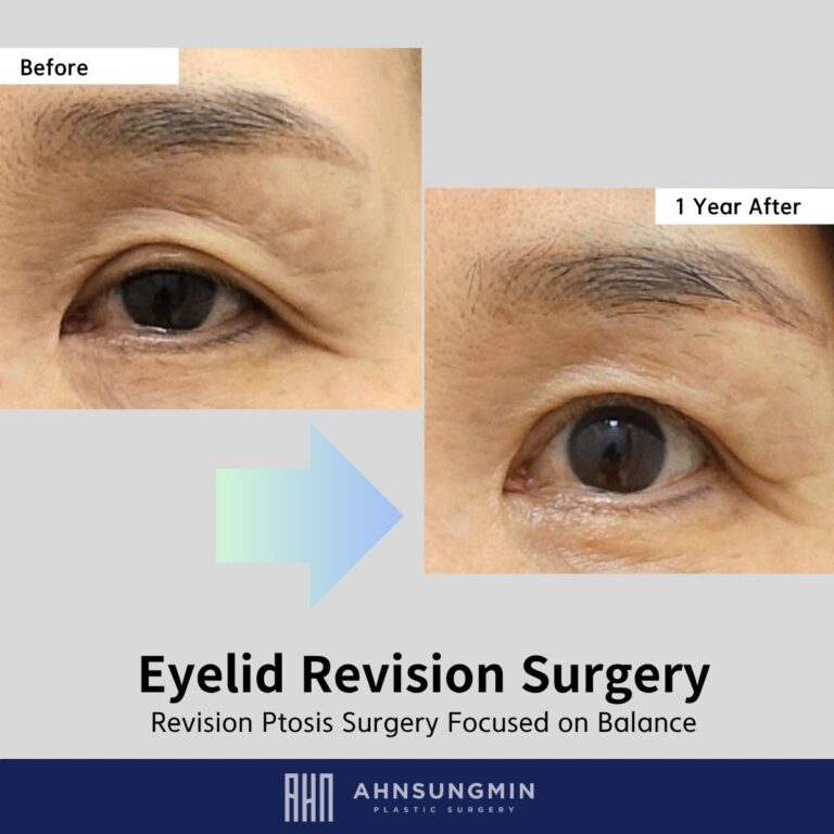 Why Revision Ptosis Surgery Should Not Focus Only on Bigger Eyes