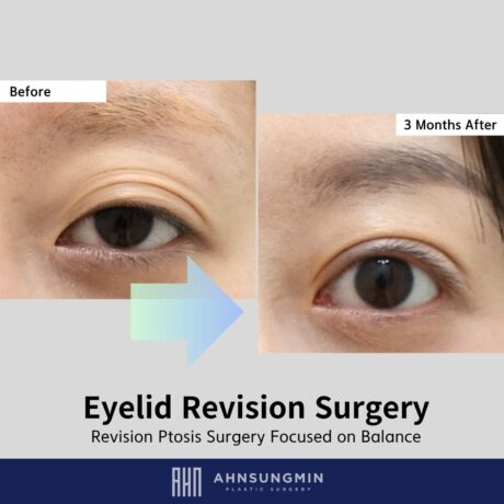 Why Revision Ptosis Surgery Sometimes Requires Skin Excision and Multiple Fold Correction.