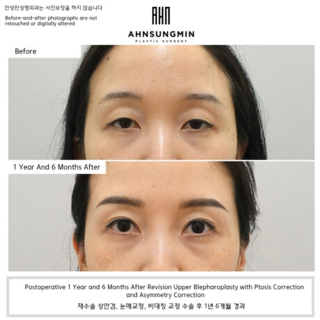 Revision Ptosis Surgery Case: Correcting Residual Ptosis and Restoring Clearer Eyelid Opening.