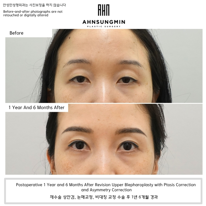 Before and 1 year 6 months after revision ptosis surgery showing clearer eyelid opening, reduced forehead compensation, and improved upper eyelid stability