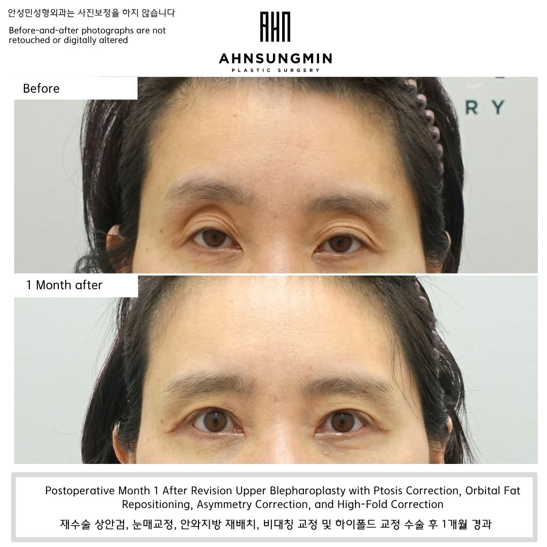 Revision upper blepharoplasty with ptosis correction and orbital fat repositioning, before and one month after surgery in Korea