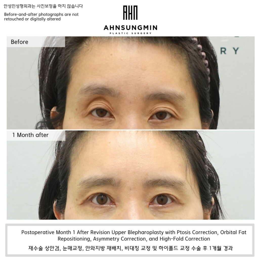 revision upper blepharoplasty with ptosis correction before and after 1 month showing improved eye opening and balanced eyelid contour