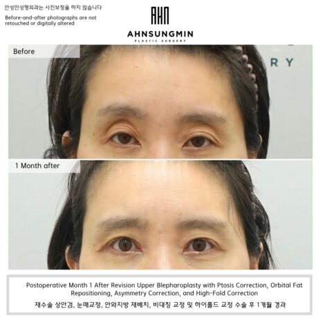 Why Do My Eyes Look Hollow Even After Double Eyelid Surgery