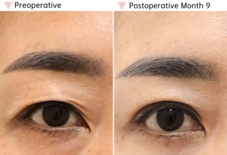 Why Does My Upper Eyelid Feel Tight After Revision Surgery?