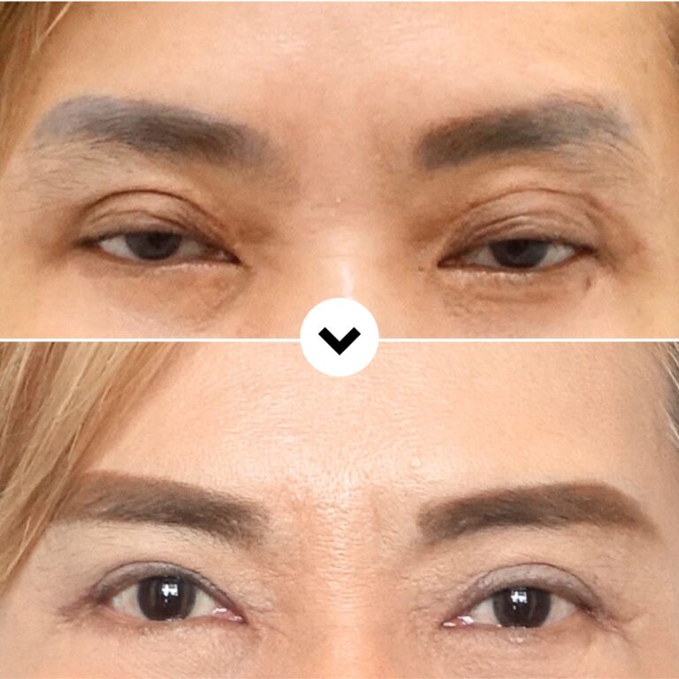 Scar Adhesion Revision After Four Previous Eyelid Surgeries