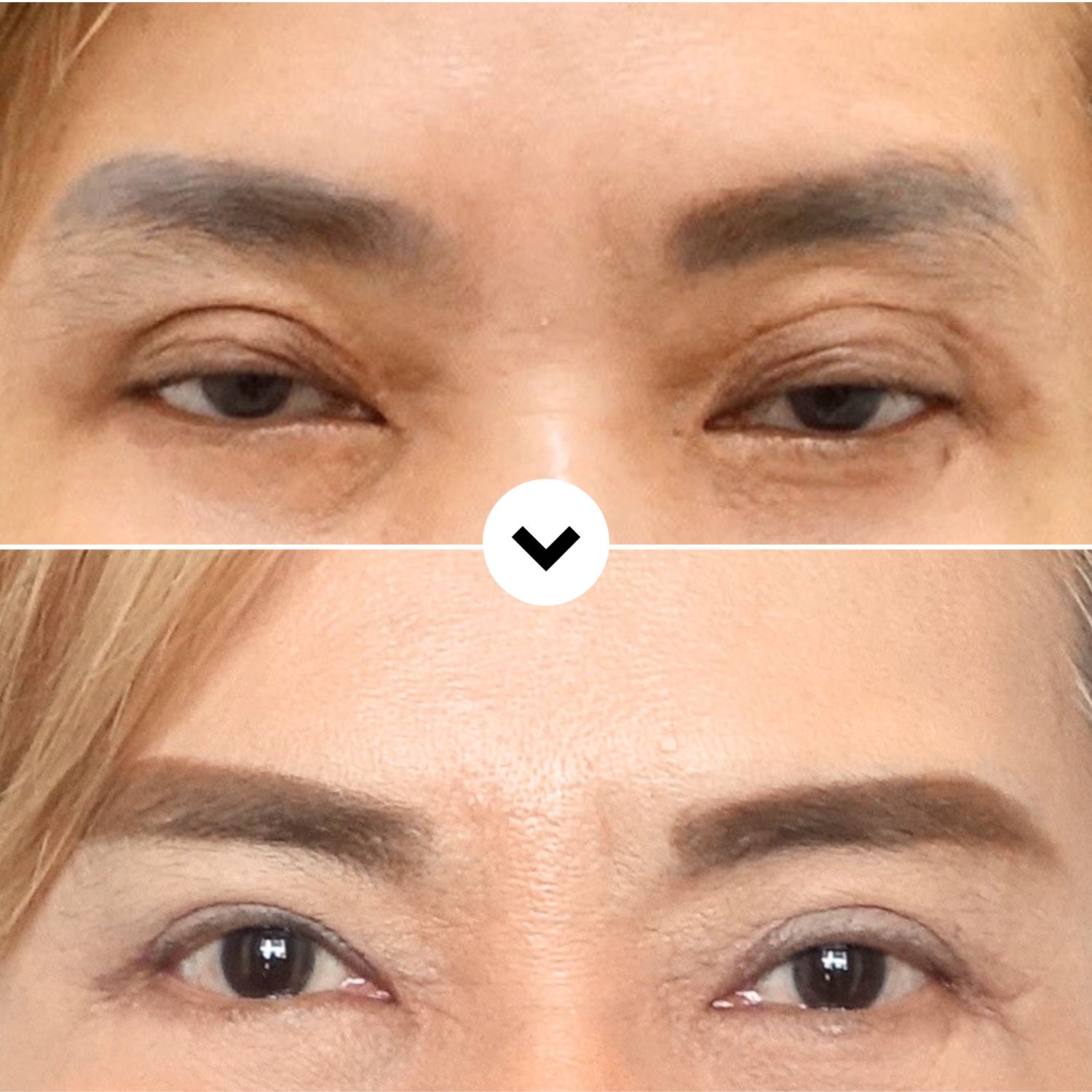 Before and postoperative day 50 comparison after scar adhesion revision eyelid surgery in Korea