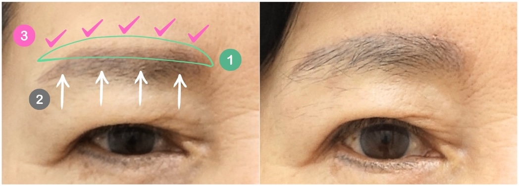 Illustration of the supra brow lift surgical concept showing incision design, brow lifting vector, and fixation suturing compared with the postoperative result.