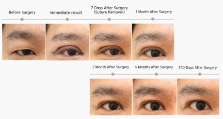 Can Swelling Make Eyelid Surgery Look Like a Failure?