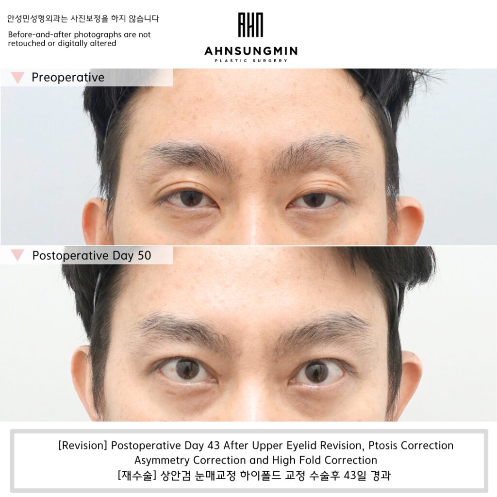 uneven eyelids after double eyelid surgery ptosis asymmetry before after