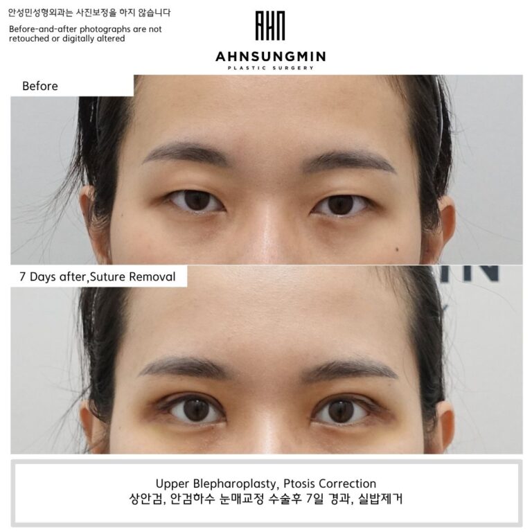 Upper Blepharoplasty and Ptosis Correction: A Brighter Eye Opening Begins Early.