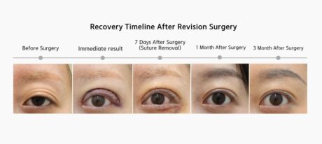 Why Your Eyes May Still Feel Heavy After Upper Blepharoplasty.