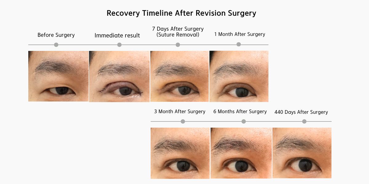 Upper Blepharoplasty Recovery Timeline Showing Healing from Before Surgery to 440 Days After Surgery