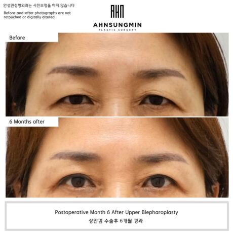 This Looked Like Ptosis, But Ptosis Correction Was Not Necessary.