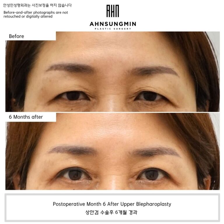 Before and 6 months after upper blepharoplasty without ptosis correction in a patient whose eyes appeared heavy before surgery