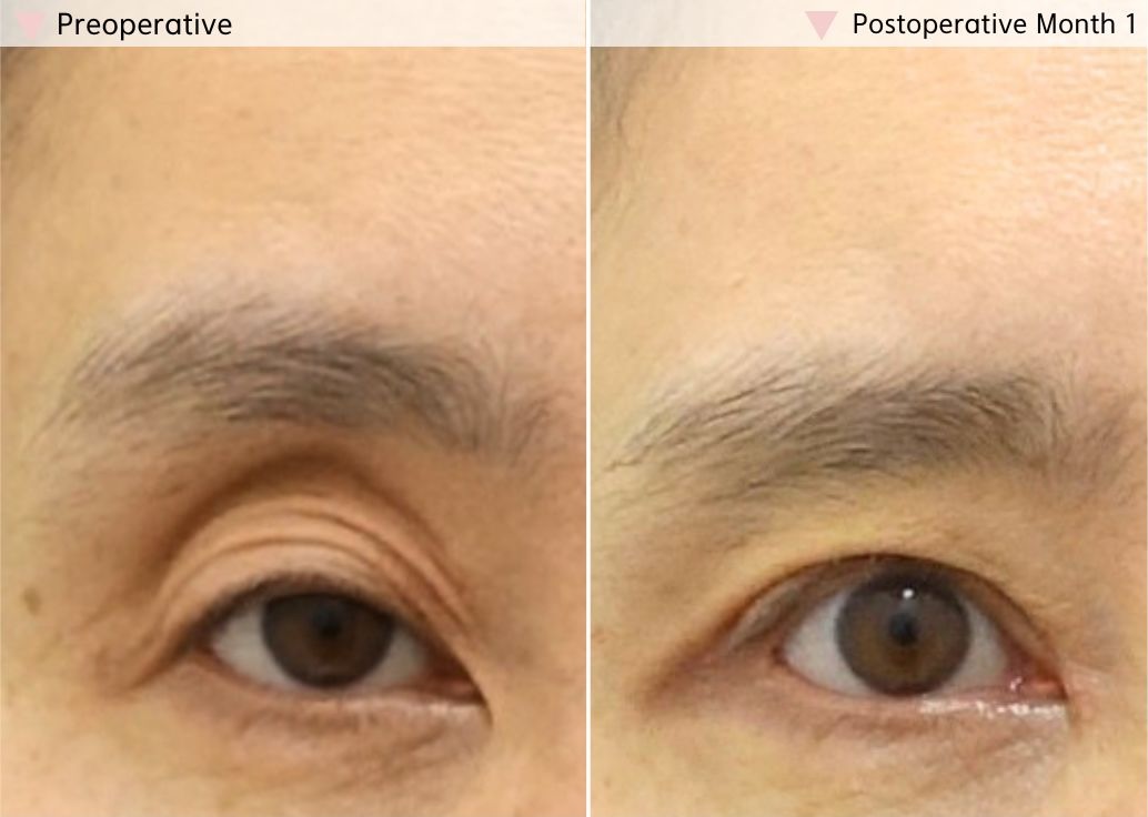 Upper eyelid fat repositioning before and after by an eyelid surgery specialist in Korea