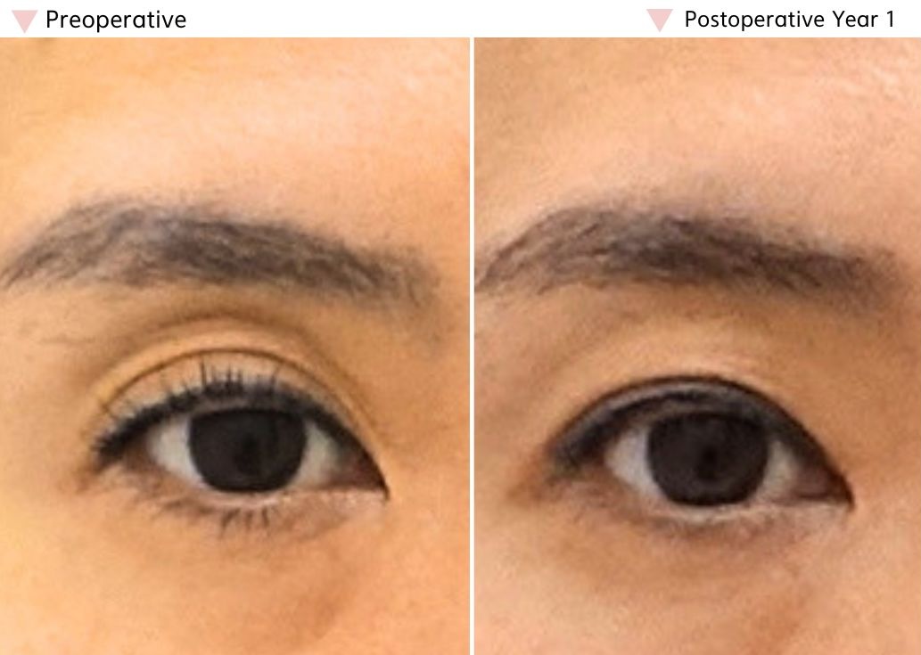 Upper eyelid hollowing improved one year after upper eyelid fat repositioning surgery in Korea.