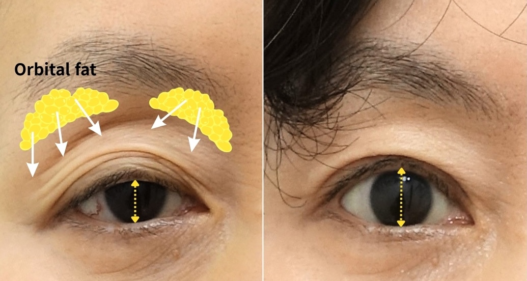 Upper eyelid fat repositioning with ptosis correction showing restoration of hollow upper eyelids through repositioning existing orbital fat and improving eyelid opening.
