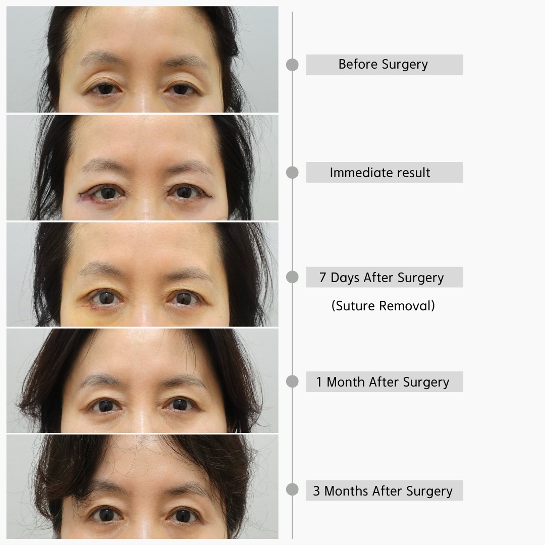 Upper eyelid fat repositioning recovery timeline showing before surgery, immediate postoperative appearance, 7 days, 1 month, and 3 months after surgery.