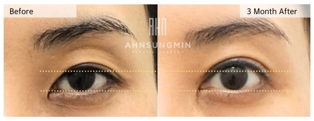 upper eyelid hollow correction fat repositioning before after without filler