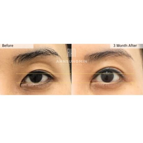 Upper Eyelid Fat Repositioning Surgery: Why It Is Not About Adding Volume