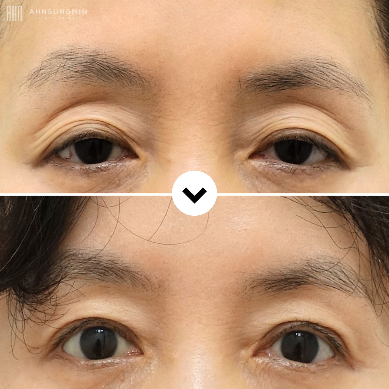 Before and after upper eyelid hollowing correction in Korea showing restored upper eyelid volume and smoother eyelid contours.