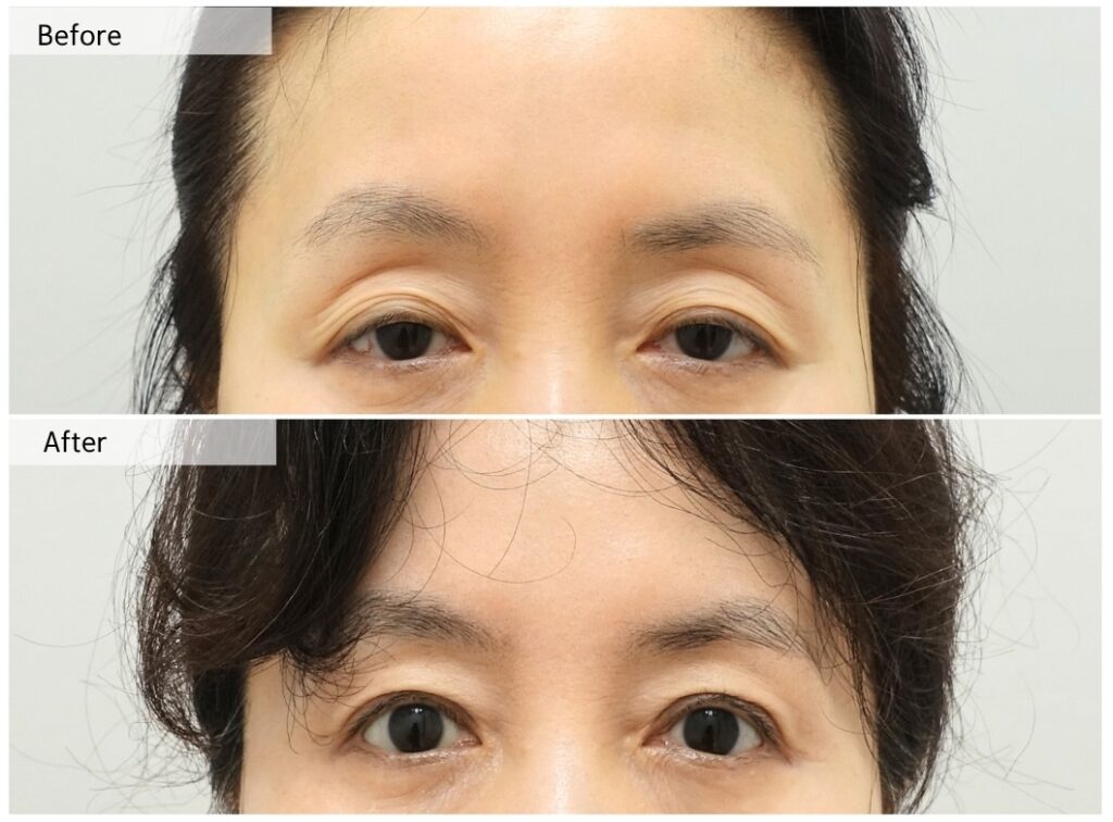 before and after ptosis correction showing improvement in hollow eyelid appearance without filler