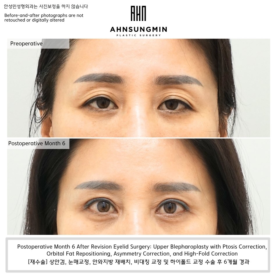 Upper eyelid hollowing revision surgery before and after with ptosis correction and fat repositioning month 6