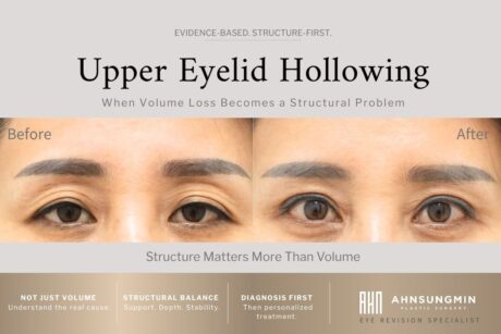 Upper Eyelid Hollowing: Why It’s Not Just a Volume Problem