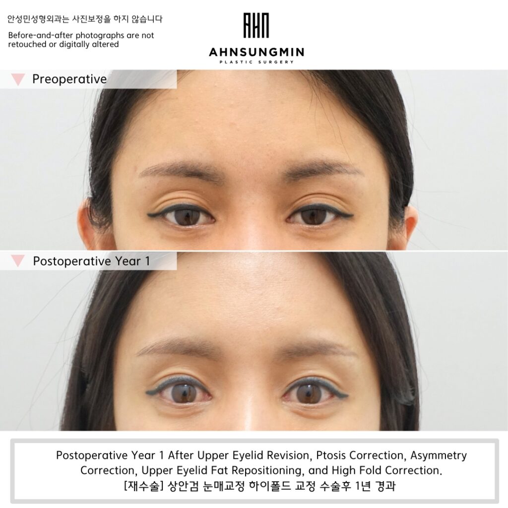 Why We Corrected Hollowing Without Adding Volume.