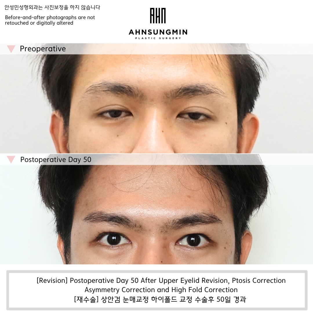 ptosis correction and high fold improvement showing natural eyelid balance after surgery
