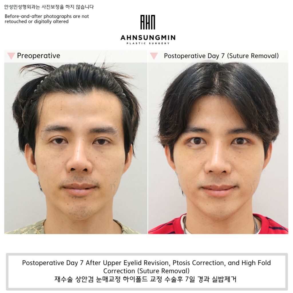 Why a High Fold Eyelid May Actually Be Ptosis | Real Case (Day 7 Results)