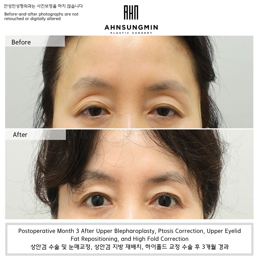 before and after ptosis correction with fat repositioning showing improvement in hollow eyelid at 3 months